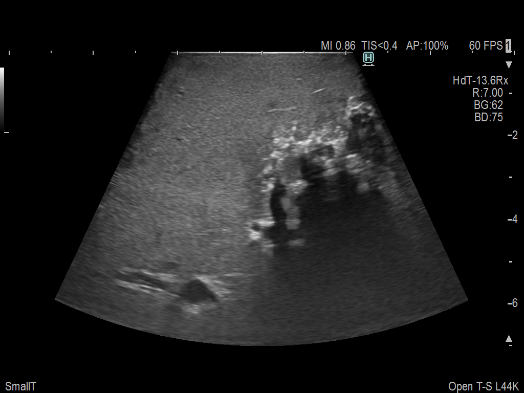 Liver Ablation Procedure using L44K