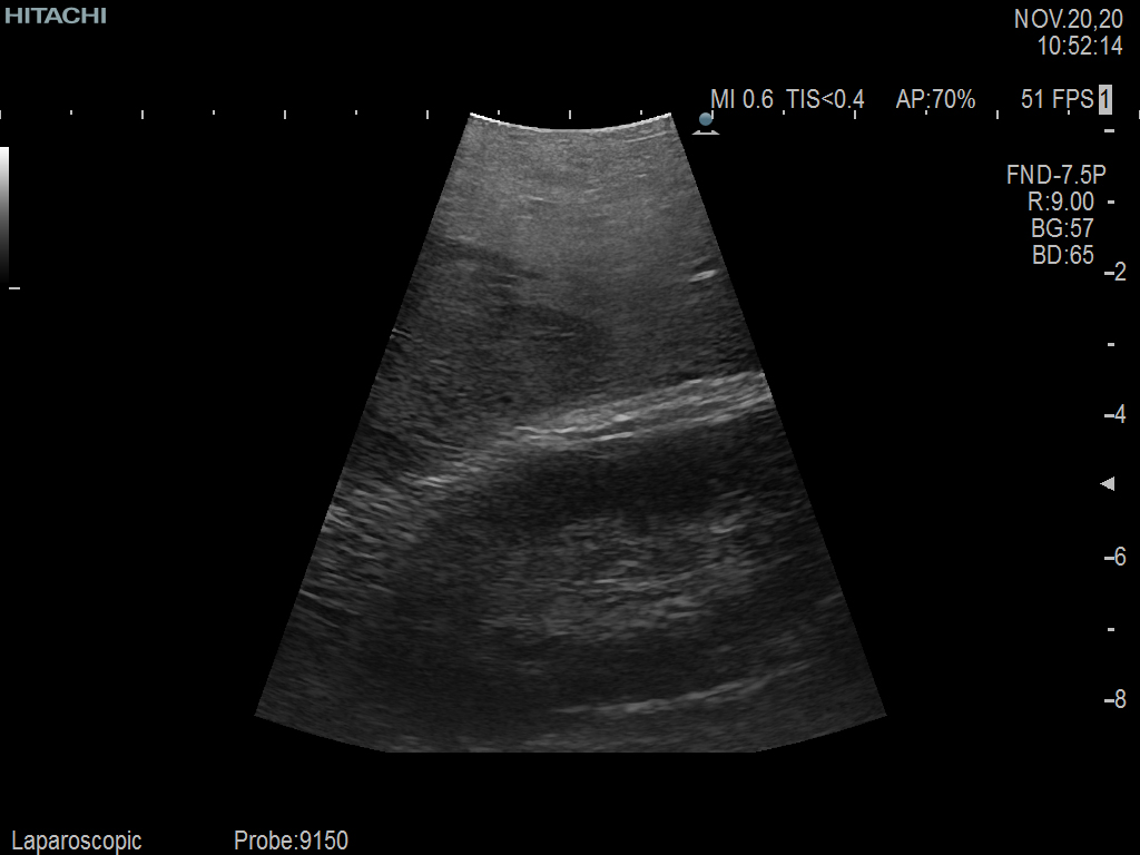 Laparoscopic Partial Nephrectomy & Hepatectomy using C9150LA