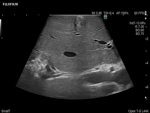 Liver Ablation Procedure using L44K