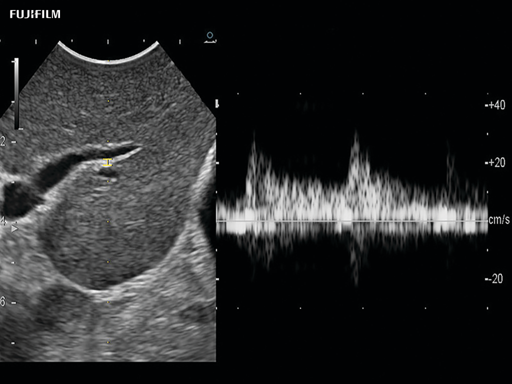 Liver Spectral Doppler using C22I