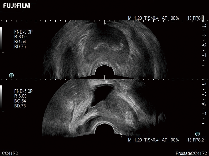 Prostate Imaging using the CC41R2 Transducer